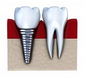 stock photo of embed  - Dental implant  - JPG 