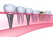 stock photo of embed  - Dental implants in the gum  - JPG 